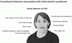 The Beginner’s Guide to Fetal Alcohol Syndrome
