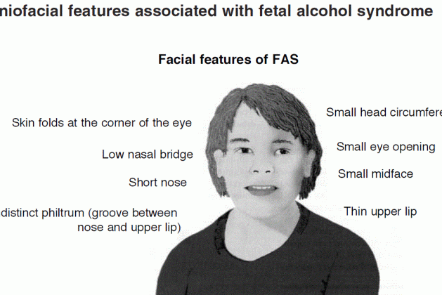 The Beginner’s Guide to Fetal Alcohol Syndrome